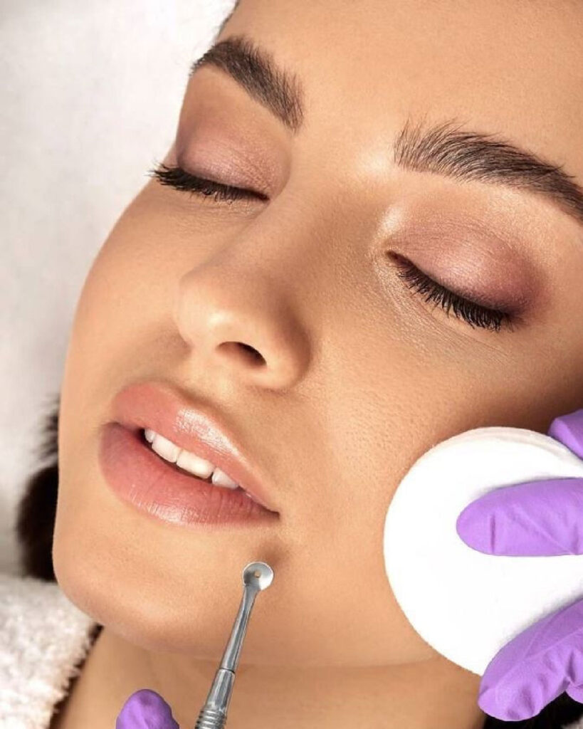 Full-Face Acne Extraction