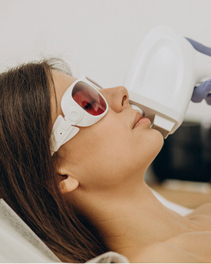 IPL Laser for Acne Treatment