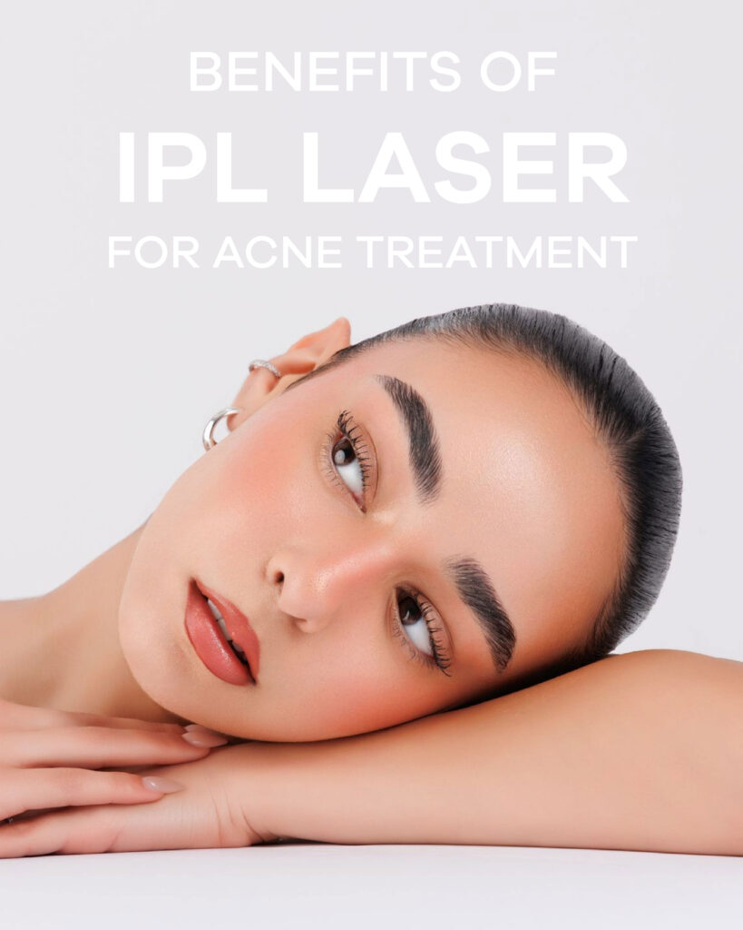 IPL Laser for Acne Treatment